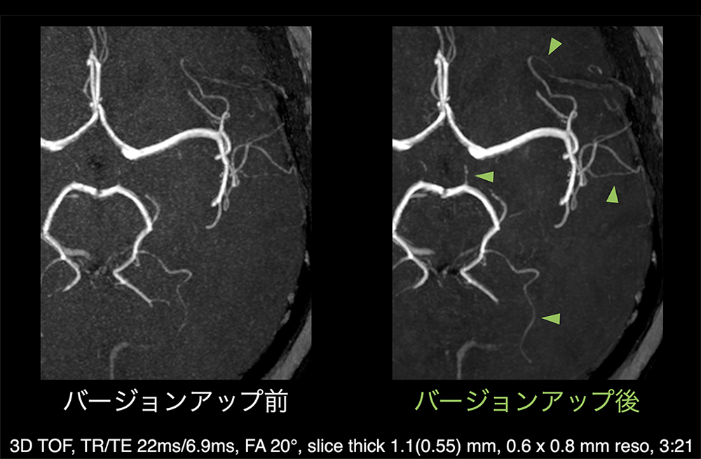 脳疾患リスクを診断するAI技術を活用したMRI－てんかんの検査・治療は京都市のしみず脳神経外科クリニック