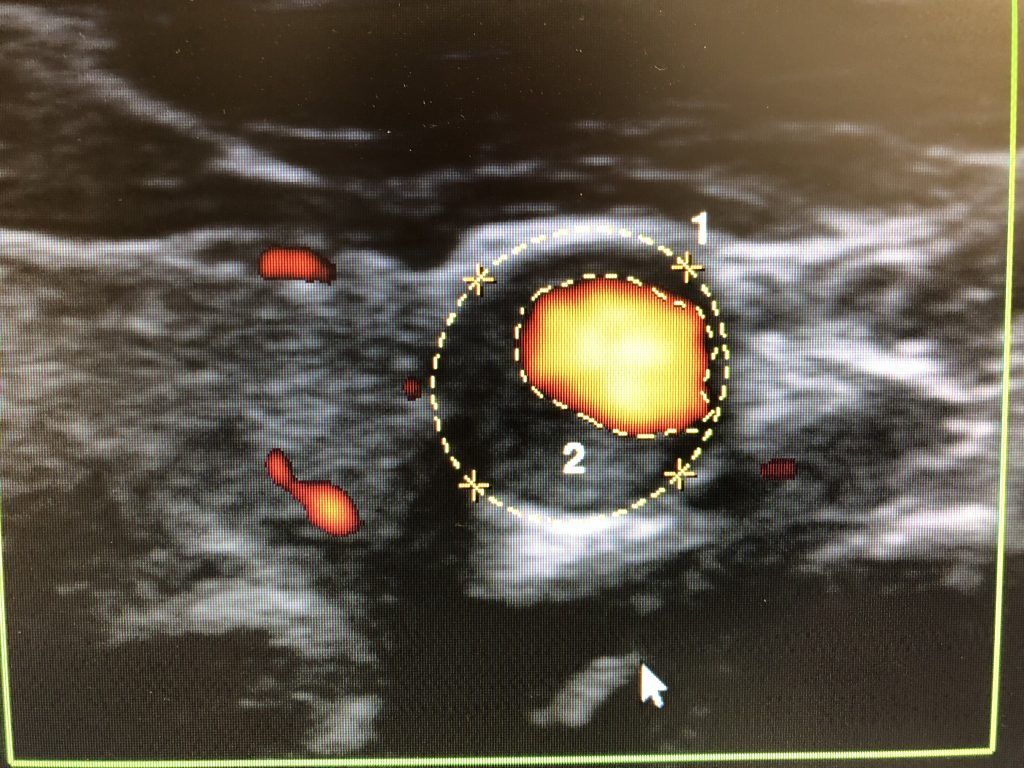 頸動脈疾患の検査